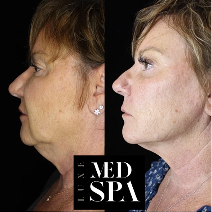 Before and after facial transformation at med spa.